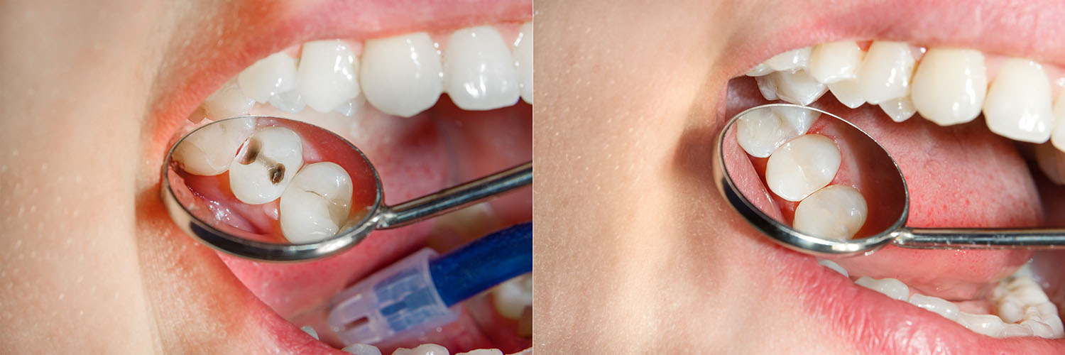Pearly Isles Dental | Sports Mouthguards, Dental Bridges and Dental Fillings
